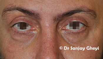 Tear Troughs before treatment